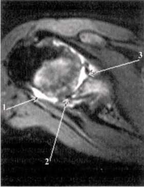 Применение МРТ-диагностики при выявлении патологических изменений локтевого сустава