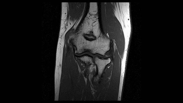 МРТ локтевого сустава