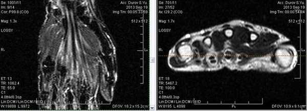 МРТ кисти: когда назначается?