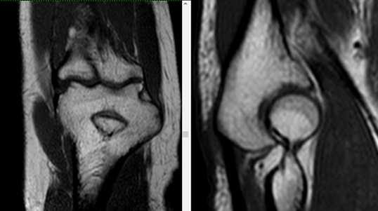 Применение МРТ-диагностики при выявлении патологических изменений локтевого сустава
