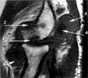 Применение МРТ-диагностики при выявлении патологических изменений локтевого сустава