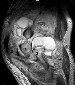 Применение МРТ-диагностики при выявлении патологических изменений локтевого сустава