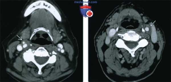 Острая идиопатическая каротидиния - лучевая диагностика