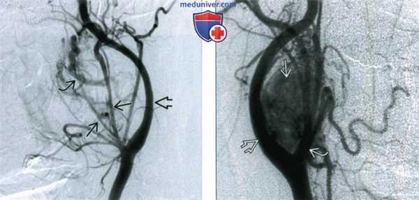 КТ, МРТ, УЗИ при каротидной параганглиоме