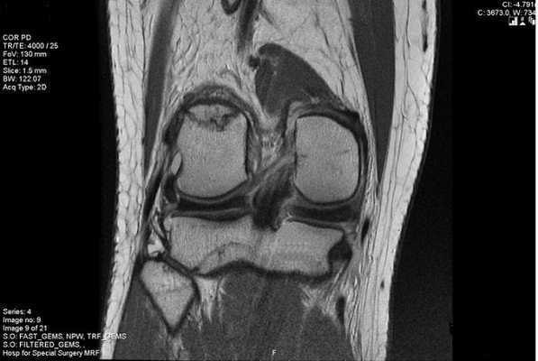 Повреждение медиального хряща на снимке МРТ