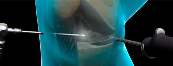 артроскопия коленного сустава