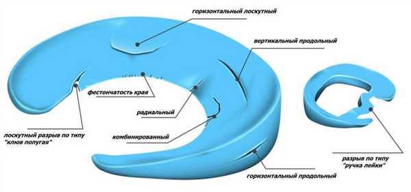 Повреждения мениска