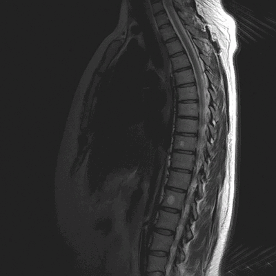 Гемангиомы на магнитно-резонансной томографии грудного отдела позвоночника