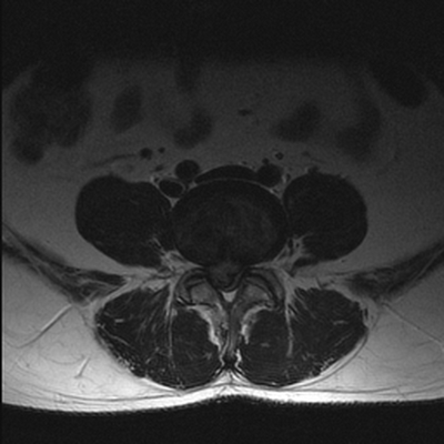 межпозвонковая грыжа на МРТ