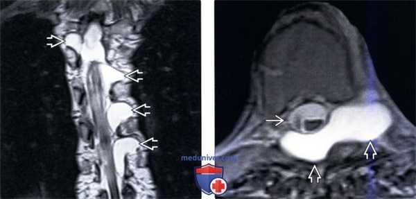 МРТ позвоночника при дисплазии соединительной ткани