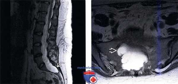 МРТ позвоночника при дисплазии соединительной ткани