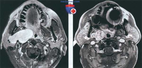 МРТ при доброкачественной смешанной опухоли околоушной железы