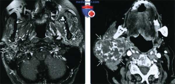 Злокачественная смешанная опухоль околоушной железы - лучевая диагностика