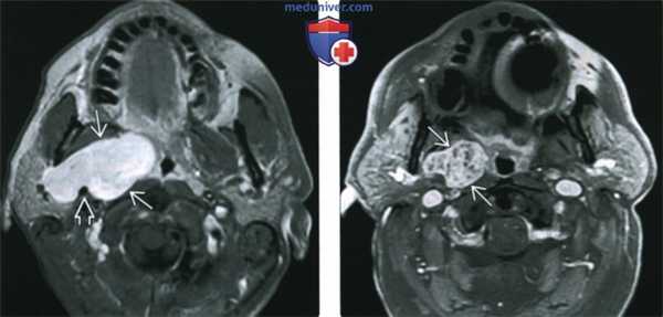 КТ, МРТ, УЗИ доброкачественной смешанной опухоли околоушной железы