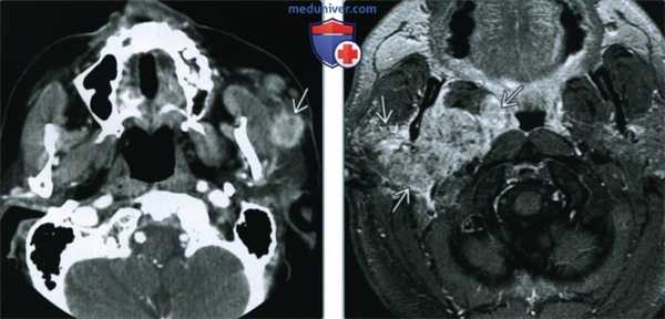 Злокачественная смешанная опухоль околоушной железы - лучевая диагностика