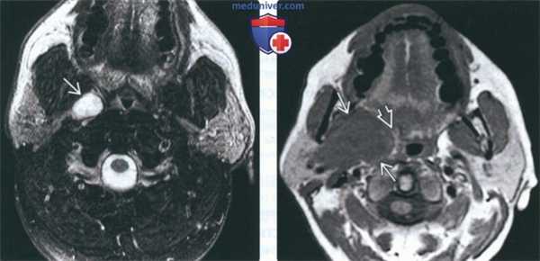 МРТ при доброкачественной смешанной опухоли околоушной железы
