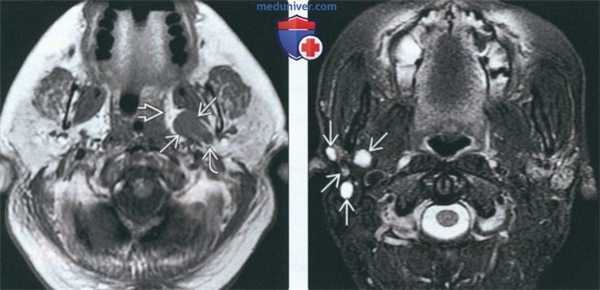 МРТ при доброкачественной смешанной опухоли околоушной железы