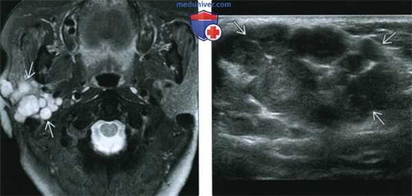 КТ, МРТ, УЗИ доброкачественной смешанной опухоли околоушной железы