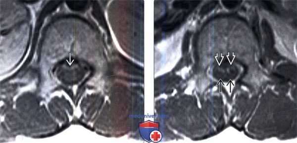МРТ при передней поясничной радикулопатии