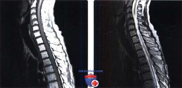 МРТ при лучевой миелопатии