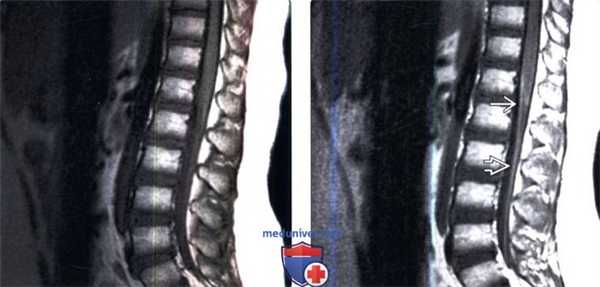 МРТ при передней поясничной радикулопатии