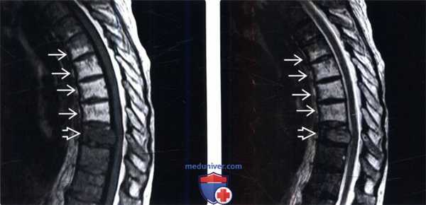 МРТ при постлучевых изменениях костного мозга