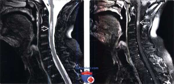 МРТ при лучевой миелопатии