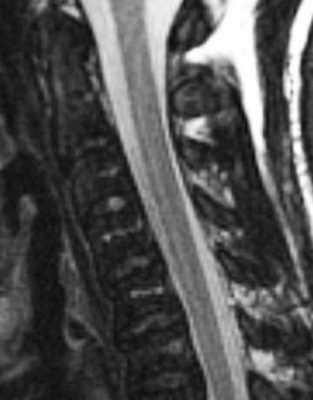 xronicheskij-mielolejkoz