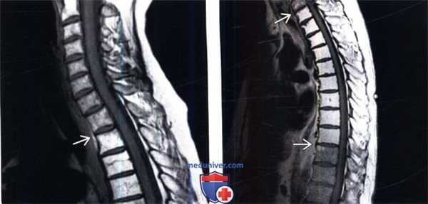 МРТ при постлучевых изменениях костного мозга