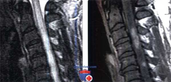 МРТ при лучевой миелопатии