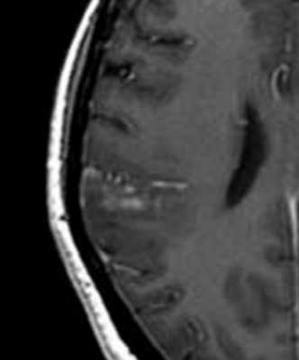 Менингиоангиоматоз