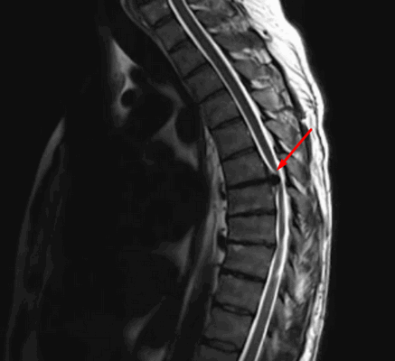 Экструзия межпозвонкового диска в поясничном отделе позвоночника на МРТ