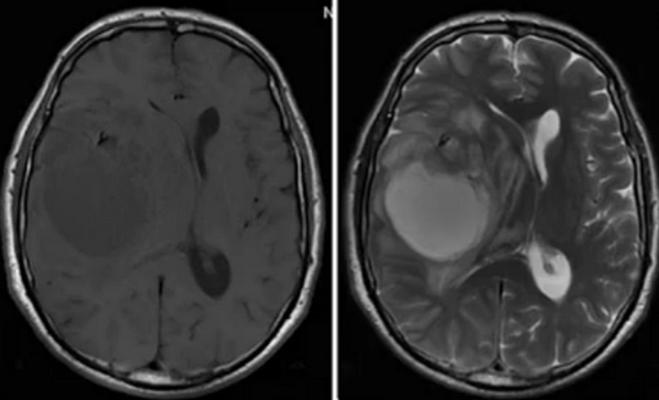 Объемное образование головного мозга на МРТ