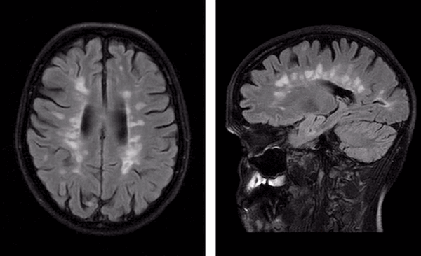 Пальцы Доусона на МРТ