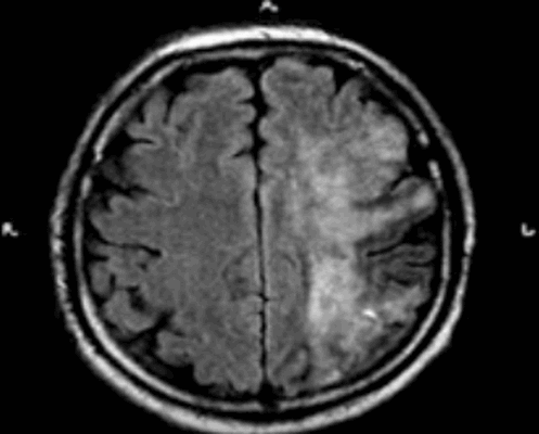 Полушарный инфаркт с геморрагическим пропитыванием на МРТ