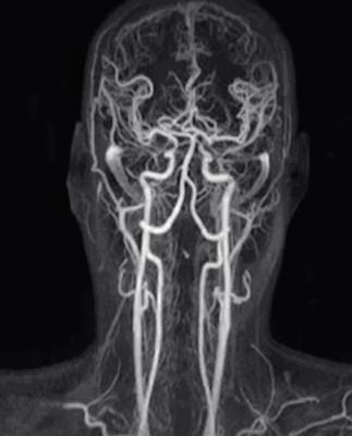МР-ангиография артерий головы и шеи