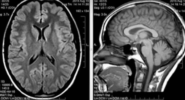 МРТ головы в норме