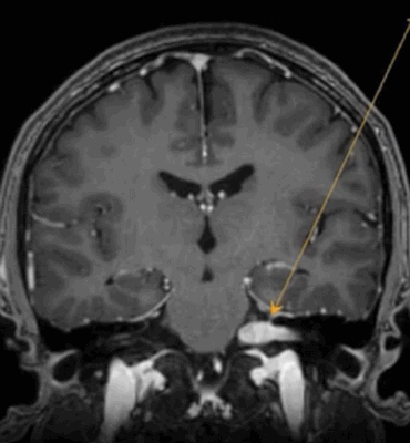 Объемное образование мосто-мозжечкового угла 