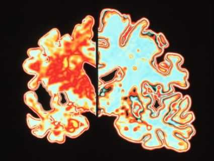 болезнь Альцгеймера в цвете