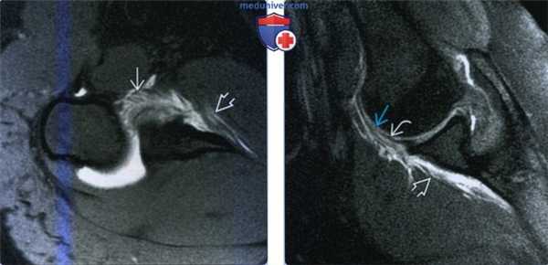 Признаки повреждения нижней суставно-плечевой связки