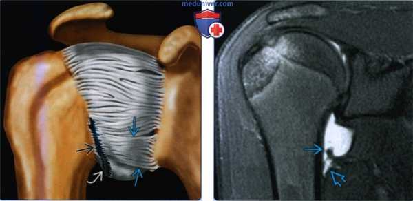 Признаки отрыва суставно-плечевой связки от плечевой кости