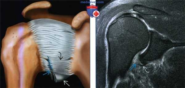 Признаки повреждения нижней суставно-плечевой связки