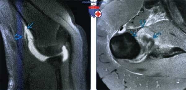 Признаки отрыва суставно-плечевой связки от плечевой кости