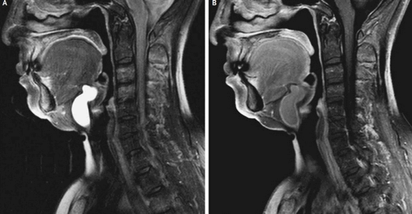 Киста шеи на МРТ