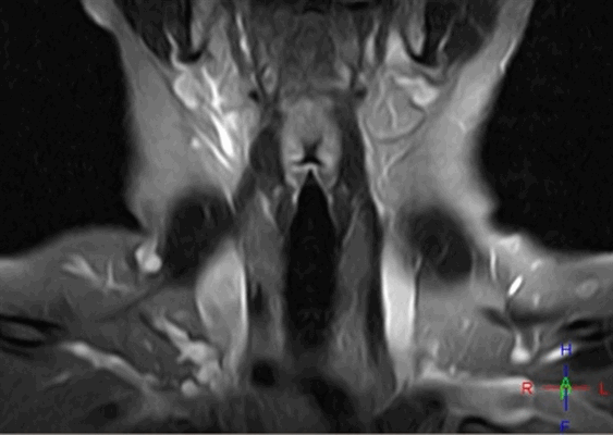 МРТ глотки и гортани