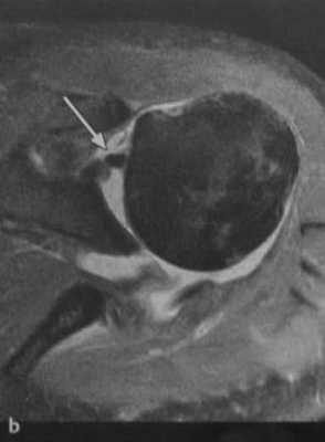 Снимки МРТ и КТ. Повреждения вращательной манжеты плеча