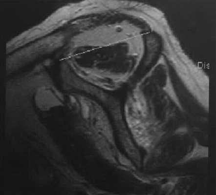 Снимки МРТ и КТ. Повреждения вращательной манжеты плеча