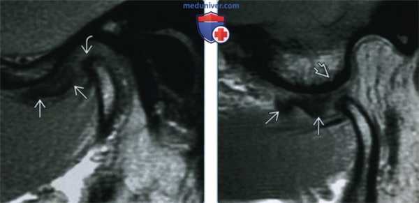 Смещение диска височно-нижнечелюстного сустава - лучевая диагностика