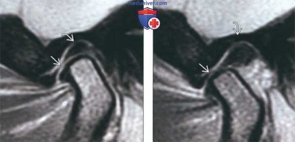 Лучевая диагностика спаек височно-нижнечелюстного сустава