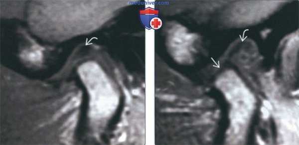 Лучевая диагностика спаек височно-нижнечелюстного сустава